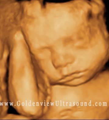 3d Ultrasound photo from Goldenview Ultrasound