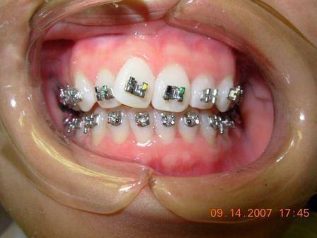 started with our custom braces