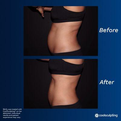 Have you met Molly? She is a real patient that completed CoolSculpting® treatments with the new and improved Elite System.  In just 3 months