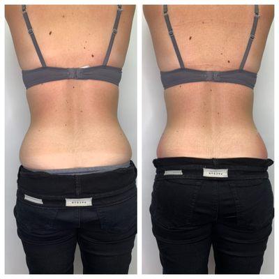 Before and after first waist bodysculpting session