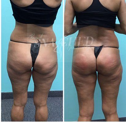 Non Surgical BBL Berrylicious Buttlift