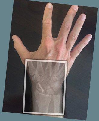 scaphoid fracture surgery