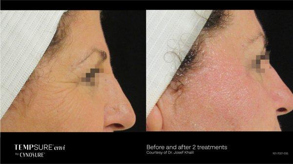 RF laser for fine lines & wrinkles