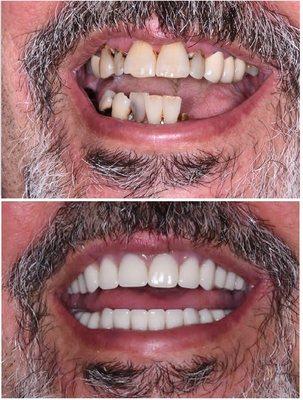 Hybrid Fixed Dentures