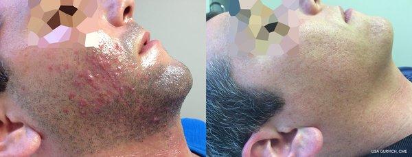 male beard / folliculitis