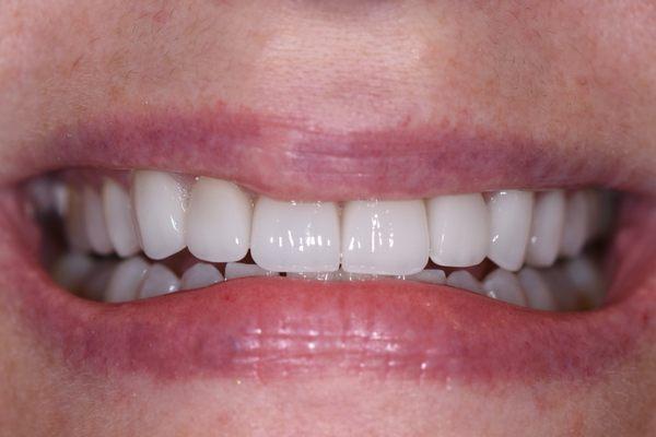 Failed tooth colored fillings replaced with porcelain veneers and crowns