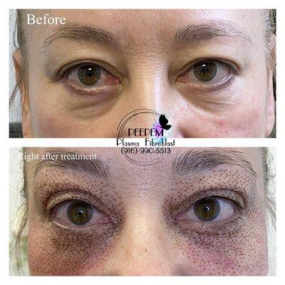 Full eyes fibroblast treatment. Say goodbye to tired-looking eyes!