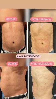 Cavi lipo