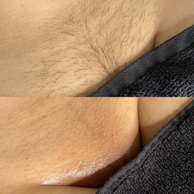 Brazilian wax