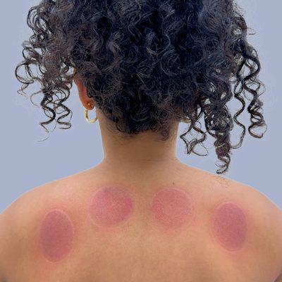 Cupping at A Plus Acupuncture & Massage Therapy located at 1300 Union Tpke #103A, in 
North New Hyde Park, NY.