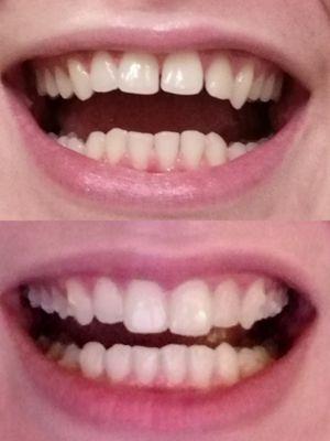 Invisalign