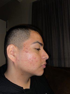 Day 1 of my 2nd peel