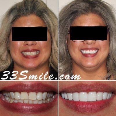 Veneers Case performed by Dr. Moore.