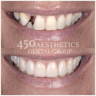 Implants and porcelain veneers