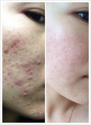 Before & After - acne treatment