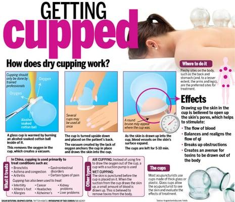 We also have cupping services.