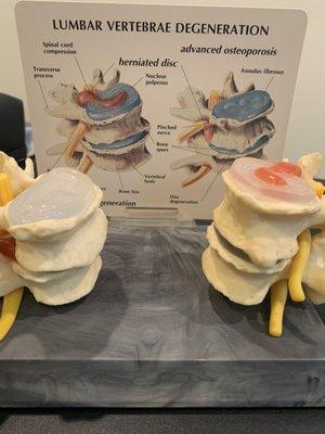 Degenerative arthritis in the Lumbar spine.