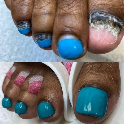 Toenail Restoration with Fungal Toenail Treatment