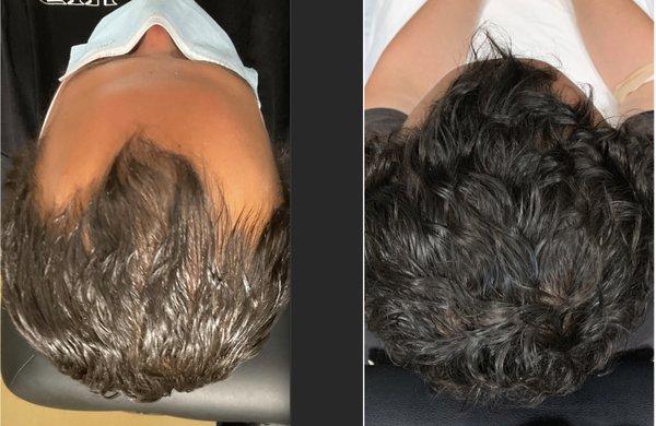 PRP Hair Restoration Works.