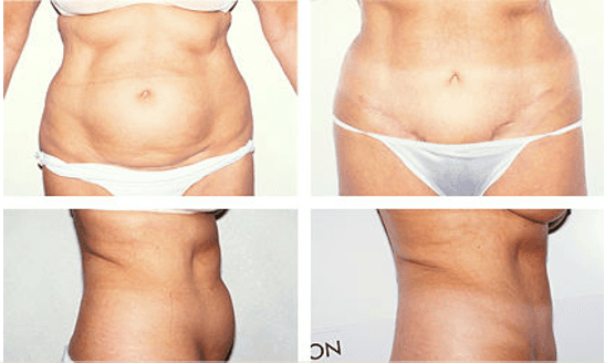 Tummy tuck. 40-45 year old female.