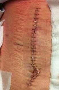 Massive incision from another surgeon that saved my life after Dr Wong botched my ERCP. Avoid this guy! From solar plexus below belly button