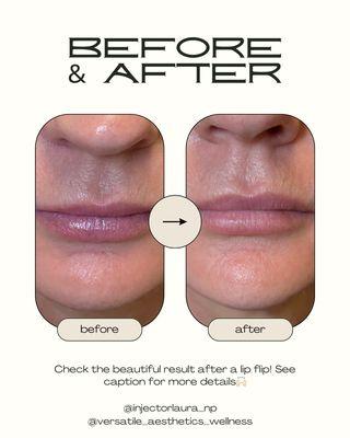 Decrease wrinkles around the lips and create a fuller appearing lip by using Botox "lip flip".