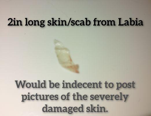 2in long blister scab from the damage to my labia... Photo's of the horrific damage to my labia would be indecent.