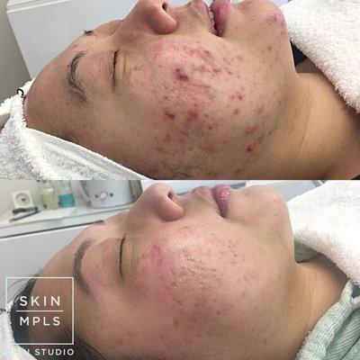 Typical results just months after closely following our Acne Treatment protocols. We treat all types and grades of acne and acne scarring.