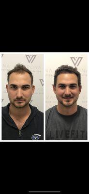 Varona Hair Restoration