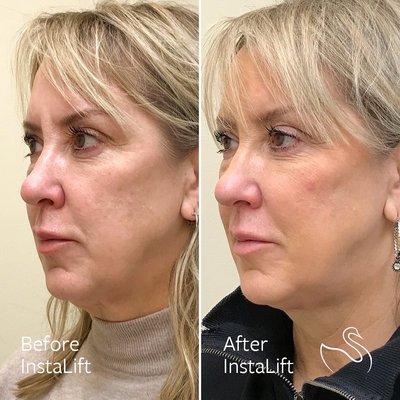 InstaLift results at The Skin Center in Pittsburgh, PA.