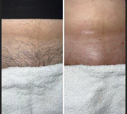 Brazilian Sugaring