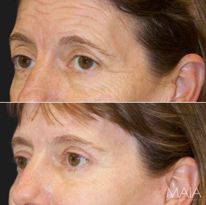 Patient showcases before-and-after results from upper and lower blepharoplasty with Dr. Maia in Tysons Corner, VA.