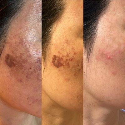 Our Patient - 3 Treatments of PicoSure Pro. The results are often practitioner dependent and it is important to see a PicoSure expert.