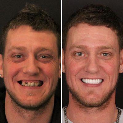 Final result of full mouth dental implants!