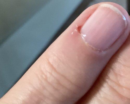 this is what the nail person did to me and blamed it on my dry cuticles...do not go here!