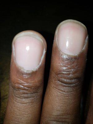 Worst trouble my nails iterally in pain