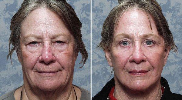 Face Lift - Blepharoplasty - Skin Resurfacing