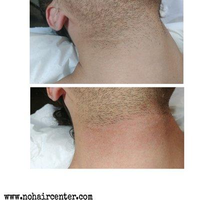 Neck clean up after 1 hour treatment