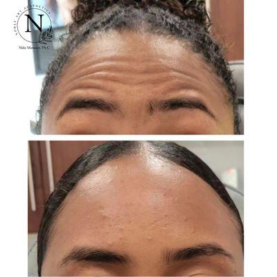 Botox Treatment Before and After