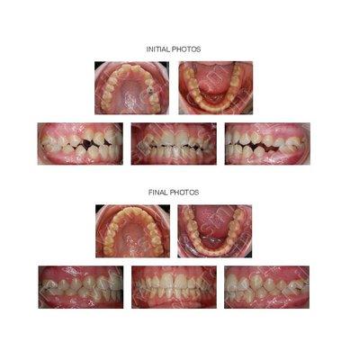 Adolescent with open bite treated with braces.