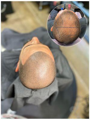 Scalp Micropigmentation