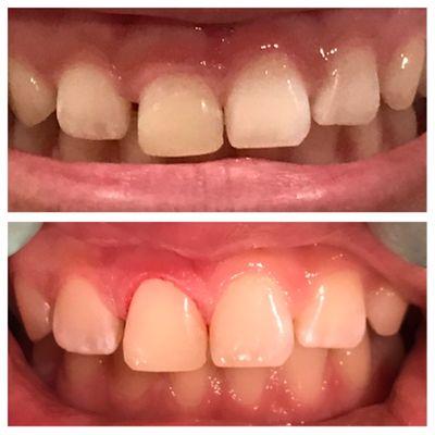 Gum recontouring , fast painless treatment makes such a difference!