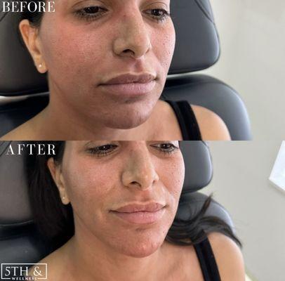 B&A Chin Filler, Immediately post Morpheus8