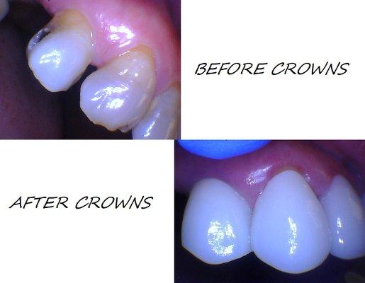 Bruxier Crowns.