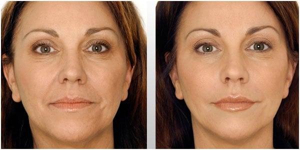 Botox and dermal fillers