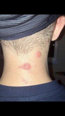 Bed bug bites.