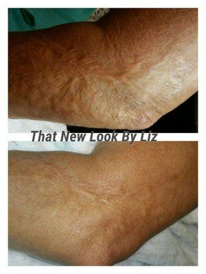 Burn scars done by micro-needling first and third session