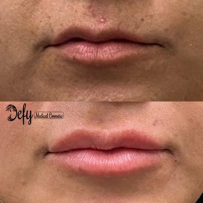 This client was extremely happy after her lip filler treatment! And so are we!!