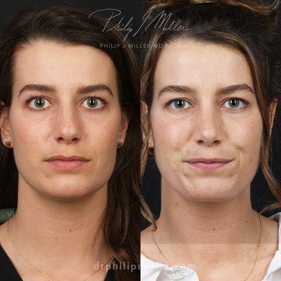 Before and after rhinoplasty.