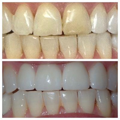 The before and after of Dr Kim's magical master work on my teeth!